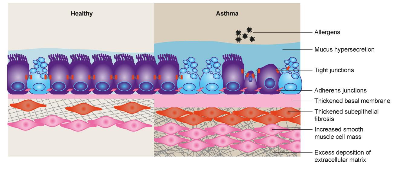 Figure 1: The airway epithelium is altered in asthma.1–3,6,16 Figure adapted from Heijink IH et al. Allergy. 2020;75:1902–1917 (with permission granted under CC license)