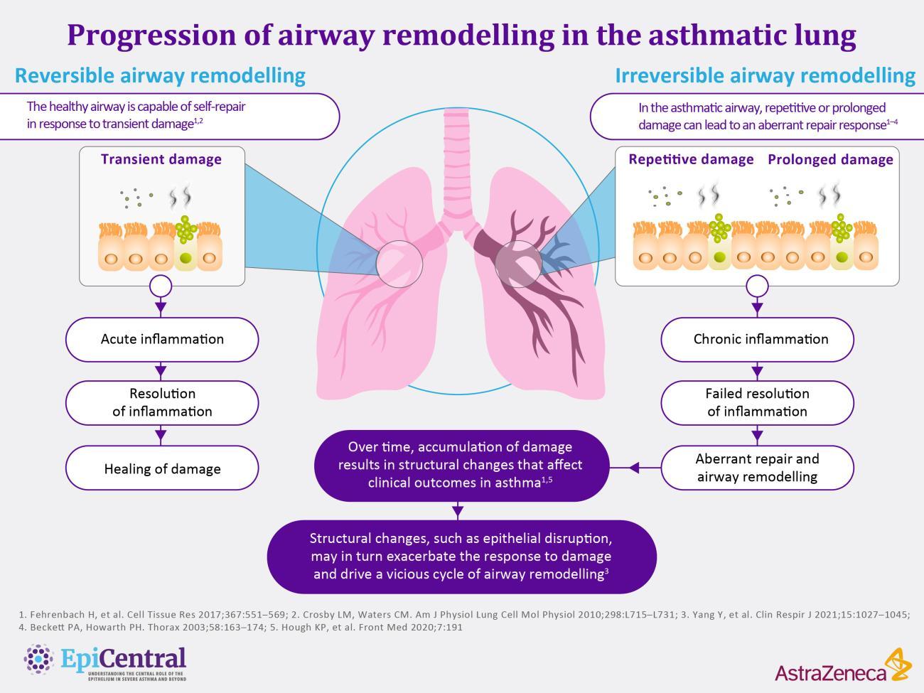 Progression of airway remodelling in the asthmatic lung